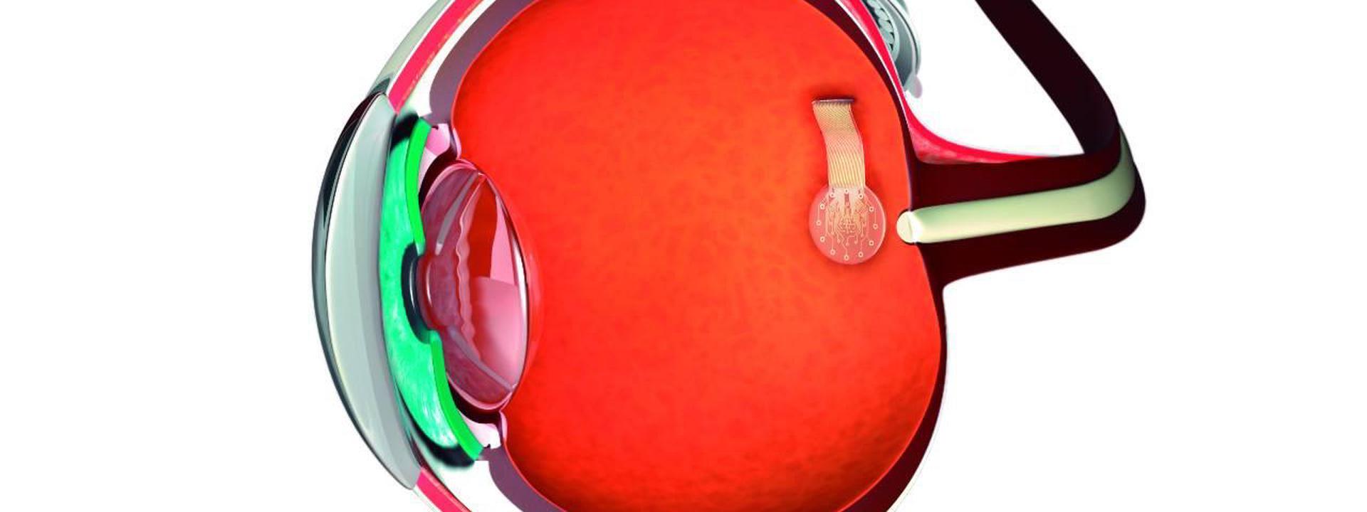 Graphretina eye