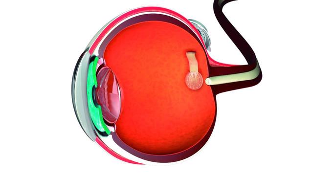 Graphretina eye
